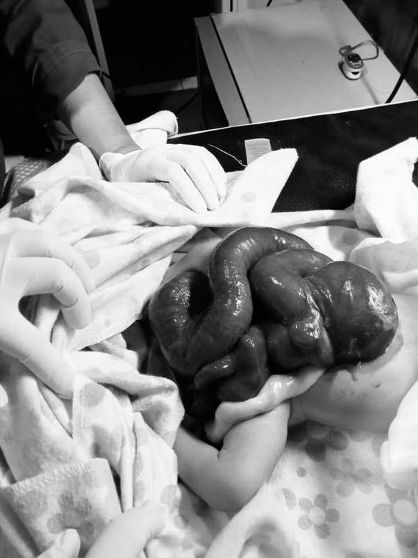 Bayi lahir dengan kelainan kongenital (Gastroschisis)